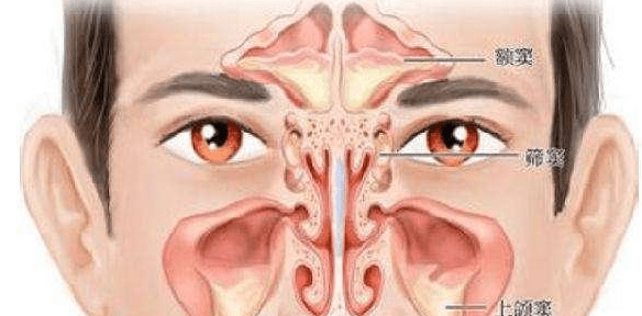 鼻窦炎为啥会引起头痛、眼痛、牙痛？